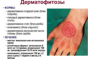 Дерматомикоз существует нескольких видов